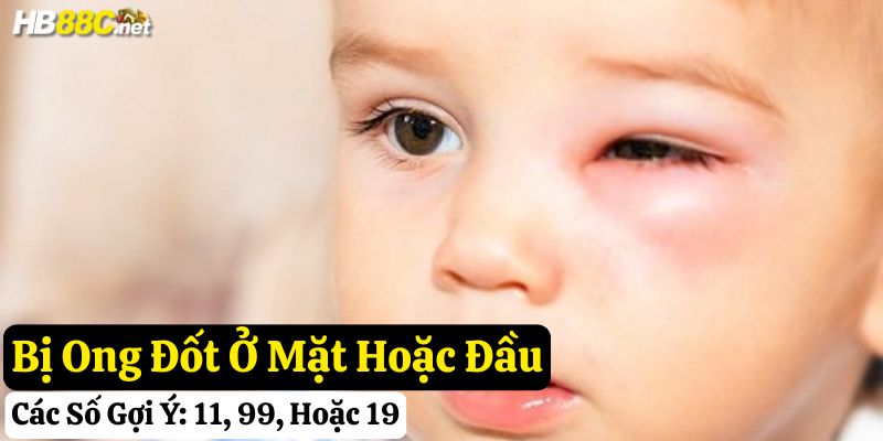 tự nhiên bị ong đốt đánh gì